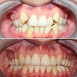 Niềng răng như thế nào để đẹp và bền vững