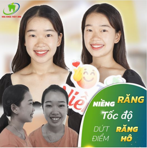NIỀNG RĂNG SIÊU TỐC ĐỘ CHỈ TỪ 7,5TR/HÀM
