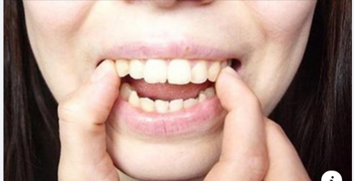 NIỀNG RĂNG TẠI NHÀ CÓ ĐƯỢC KHÔNG?