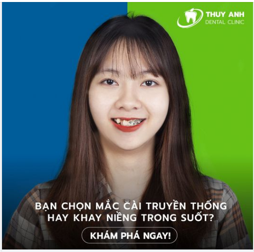 NIỀNG RĂNG VÔ HÌNH - Quên đi phiền phức khi niềng răng với mắc cài truyền thống.