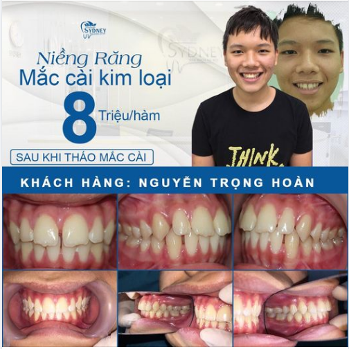 NIỀNG RĂNG VỪA TIẾT KIỆM VỪA HIỆU QUẢ