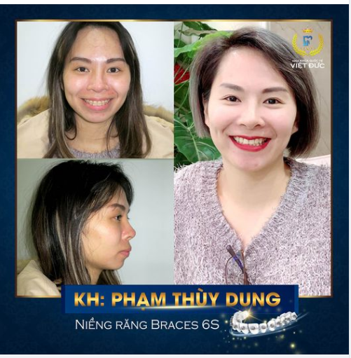 Niềng răng xong Cười xinh hết cỡ