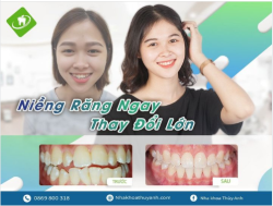 NIỀNG SỚM ĐẸP SỚM, NHẬN NHIỀU LỢI ÍCH