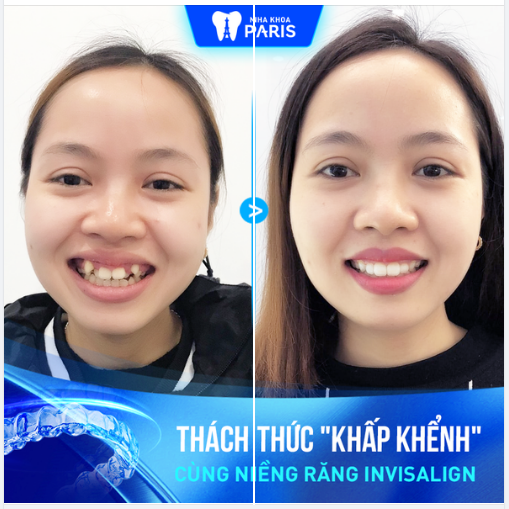  Niềng trong suốt chỉ từ 36TR
