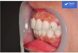 Nói về góc nghiêng, một ca răng sứ thành công về mặt thẩm mỹ phải góp phần tạo nên một “góc nghiêng thần thánh” trên khuôn mặt cũng như nụ cười.