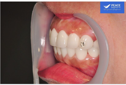 Nói về góc nghiêng, một ca răng sứ thành công về mặt thẩm mỹ phải góp phần tạo nên một “góc nghiêng thần thánh” trên khuôn mặt cũng như nụ cười.