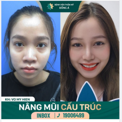 Nụ cười rạng rỡ của chị Hiền sau 10 ngày NÂNG MŨI tại Đông Á