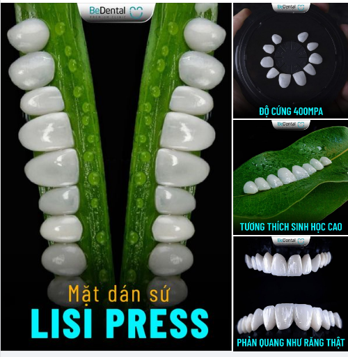 NỤ CƯỜI TỎA SÁNG NHỜ MẶT DÁN SỨ LISI PRESS