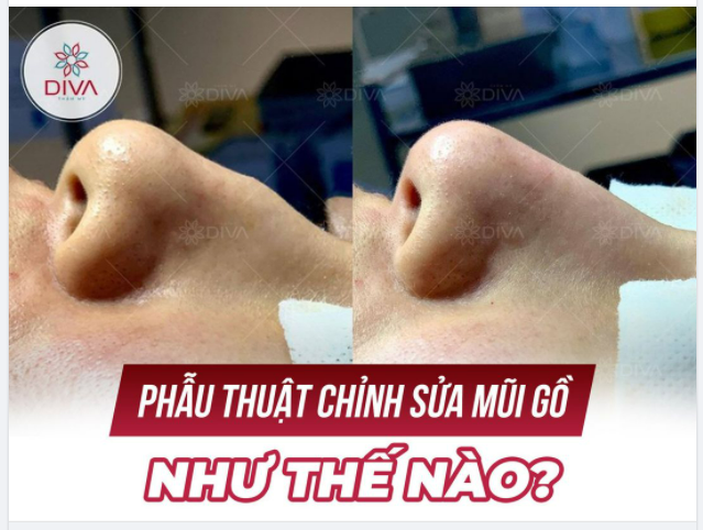 PHẪU THUẬT CHỈNH SỬA MŨI GỒ NHƯ THẾ NÀO?