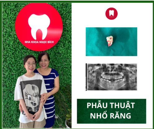 PHẪU THUẬT NHỔ BỎ RĂNG - TRÁNH BIẾN CHỨNG