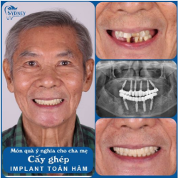 PHỤC HÌNH TOÀN HÀM - ĂN NHAI THOẢI MÁI