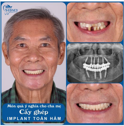 PHỤC HÌNH TOÀN HÀM - ĂN NHAI THOẢI MÁI