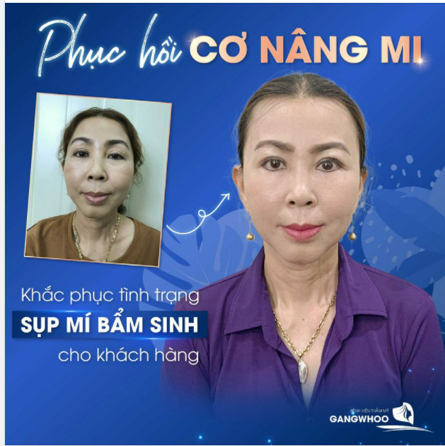 PHỤC HỒI CƠ NÂNG MI - KHẮC PHỤC TÌNH TRẠNG SỤP MÍ BẨM SINH CHO KHÁCH HÀNG
