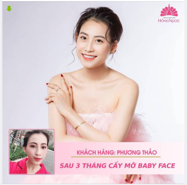 PHƯƠNG THẢO BIẾN ĐỔI NGOẠN MỤC SAU 3 THÁNG CẤY MỠ BABY FACE
