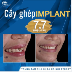 QUY TRÌNH CẤY GHÉP IMPLANT CHUẨN AN TOÀN QUỐC TẾ