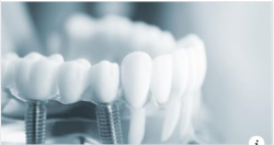 QUY TRÌNH CẤY IMPLANT ĐƯỢC THỰC HIỆN NHƯ THẾ NÀO