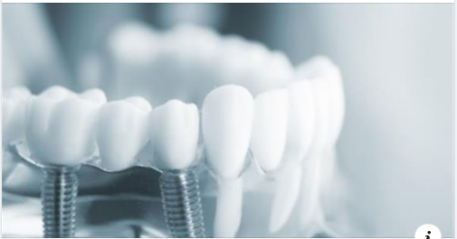QUY TRÌNH CẤY IMPLANT ĐƯỢC THỰC HIỆN NHƯ THẾ NÀO