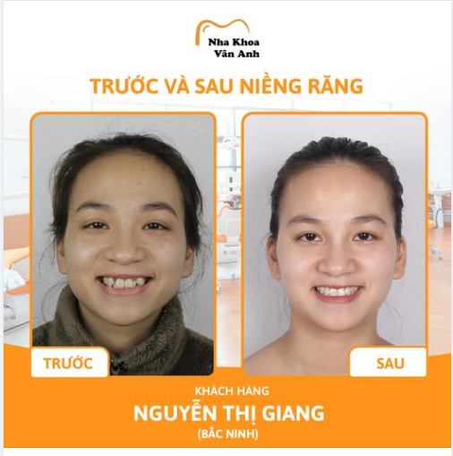 QUY TRÌNH KHÁM NIỀNG RĂNG CHUẨN QUỐC TẾ TẠI NHA KHOA VÂN ANH