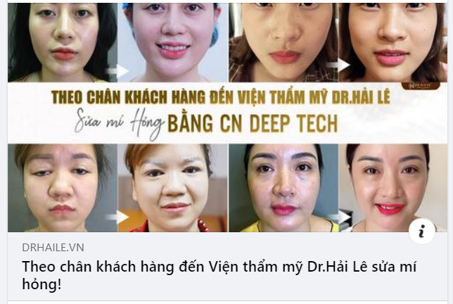 Quyết định cắt mí tại một cơ sở thiếu uy tín nhiều khách hàng tìm đến Dr.Hải Lê trong tình trạng mí lỗi trầm trọng.