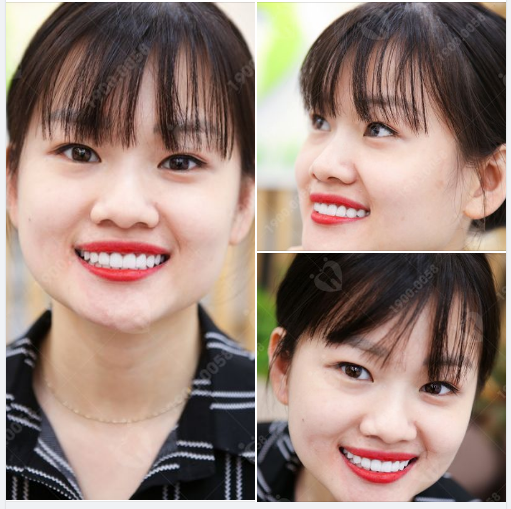 QUYẾT TÂM LÀM ĐẸP – LẤY LẠI SỰ TỰ TIN CHO NỤ CƯỜI