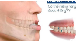 RĂNG BỊ MÓM CÓ NIỀNG ĐƯỢC KHÔNG