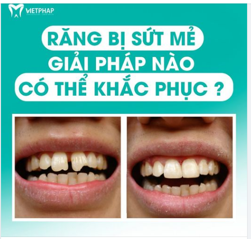 RĂNG BỊ SỨT MẺ - GIẢI PHÁP NÀO CÓ THỂ KHẮC PHỤC