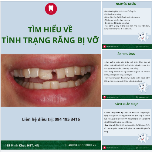 Răng bị vỡ có thể gây ra nhiều ảnh hưởng không tốt đến sức khỏe và tinh thần của người bệnh nếu không được khắc phục kịp thời.