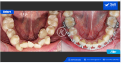 Răng chen chúc (crowding) là tình trạng thường gặp nhất, chiếm tỉ lệ cao nhất trong rối loạn khớp cắn.