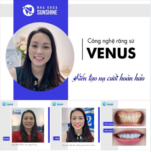 RĂNG ĐẸP RẠNG NGỜI CHO NỤ CƯỜI TOẢ NẮNG