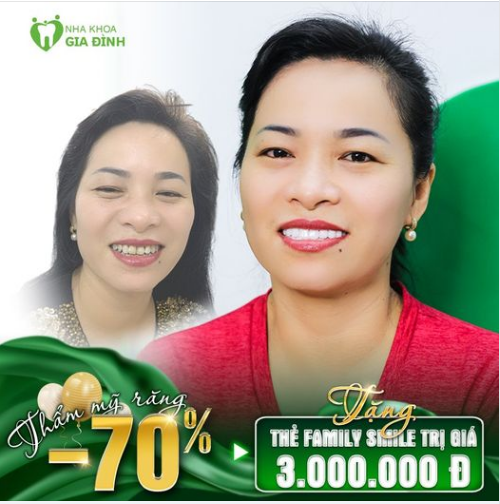 RĂNG ĐẸP TỈ LỆ VÀNG – CHI PHÍ CỰC NHẸ NHÀNG