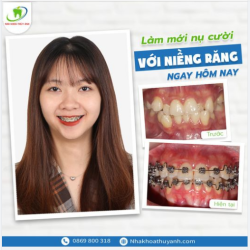 RĂNG ĐỀU ĐẸP CHỈ SAU 6 THÁNG ĐEO NIỀNG