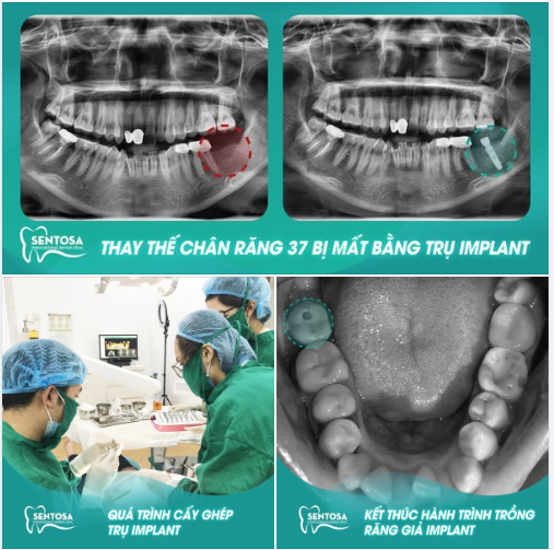 RĂNG GIẢ IMPLANT DÙNG NHƯ RĂNG THẬT