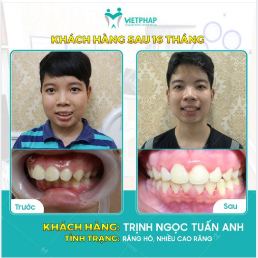 RĂNG HÔ, VẨU KHẮC PHỤC THẾ NÀO
