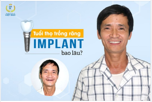 RĂNG IMPLANT CÓ TUỔI THỌ BAO LÂU
