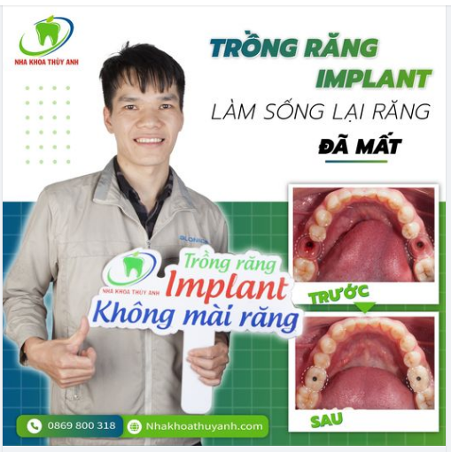 RĂNG IMPLANT - TRỒNG RĂNG KHÔNG MÀI RĂNG