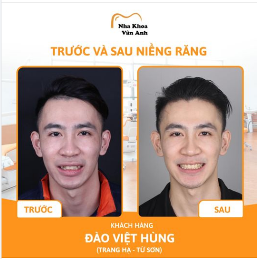 RĂNG KHẤP KHỂNH khiến bạn tự ti, ngại ngùng mỗi khi giao tiếp