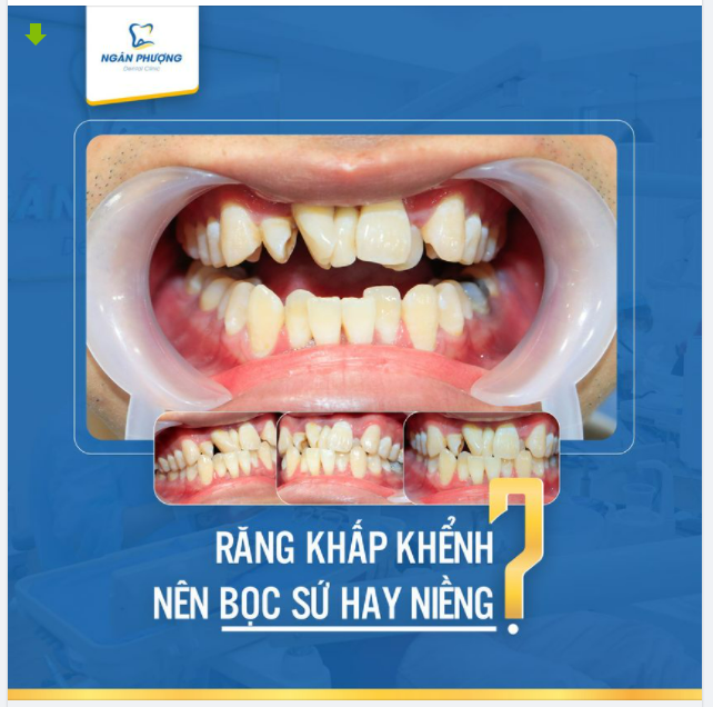 RĂNG KHẤP KHỂNH NÊN NIỀNG HAY BỌC SỨ?