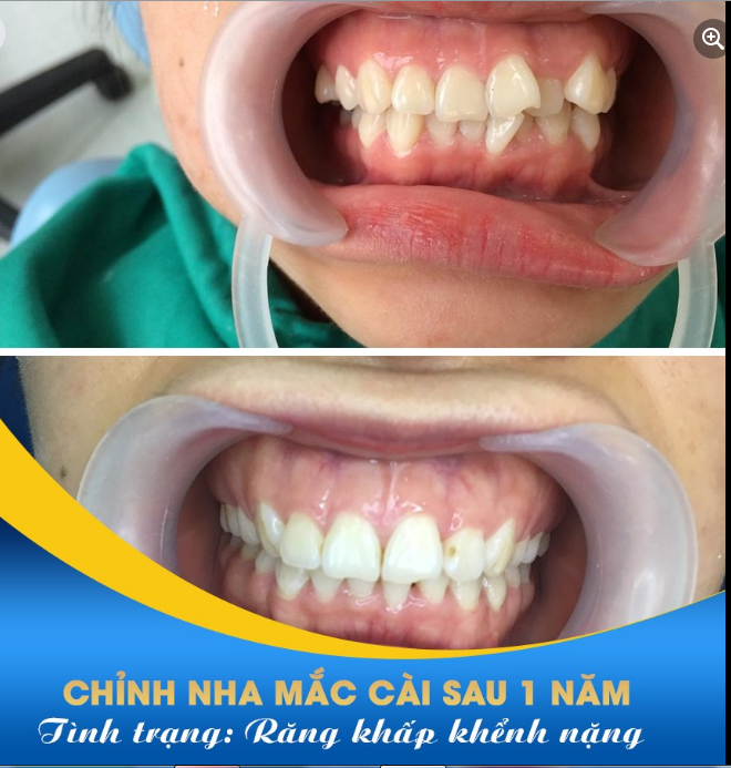 RĂNG KHẤP KHỂNH QUÁ THÌ PHẢI LÀM SAO