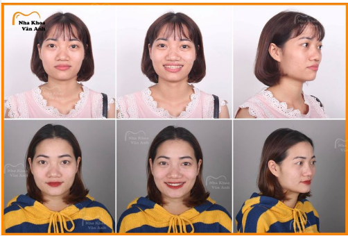 RĂNG KHẤP KHỂNH THÌ PHẢI NIỀNG RĂNG