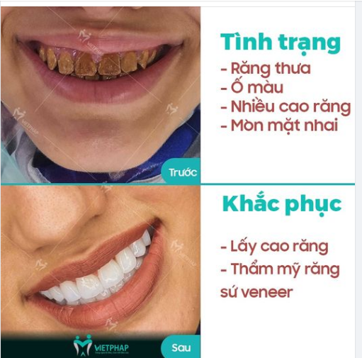 RĂNG NHIỄM MÀU, MÒN MẶT NHAI LÀM THẾ NÀO ĐỂ KHẮC PHỤC
