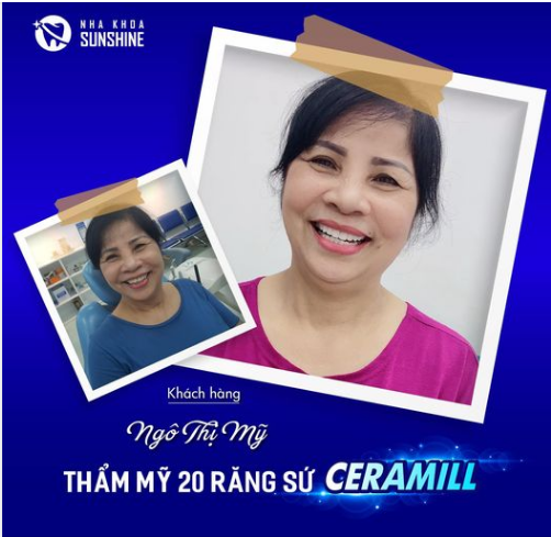 RĂNG SỨ CERAMILL ĐẠI SỨ CHO NỤ CƯỜI HOÀN HẢO