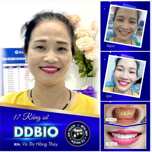 RĂNG SỨ DDBIO SỞ HỮU NỤ CƯỜI RẠNG RỠ