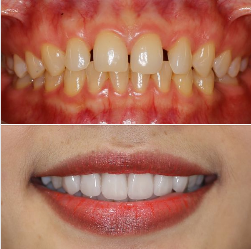 Răng sứ EMAX có đặc điểm màu sắc tự nhiên, hài hòa như răng thật