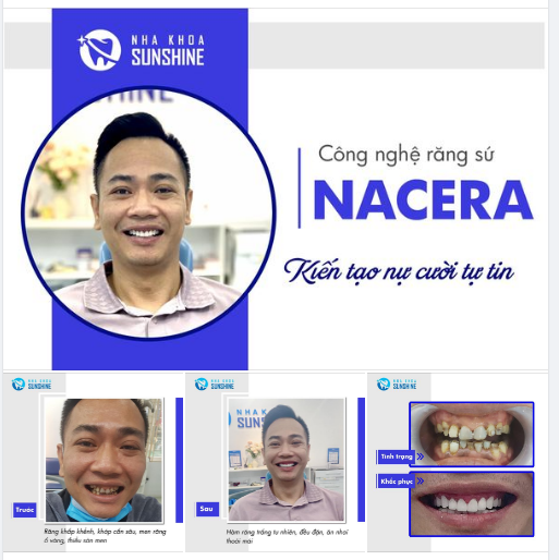 RĂNG SỨ NACERA KIẾN TẠO NỤ CƯỜI TỰ TIN