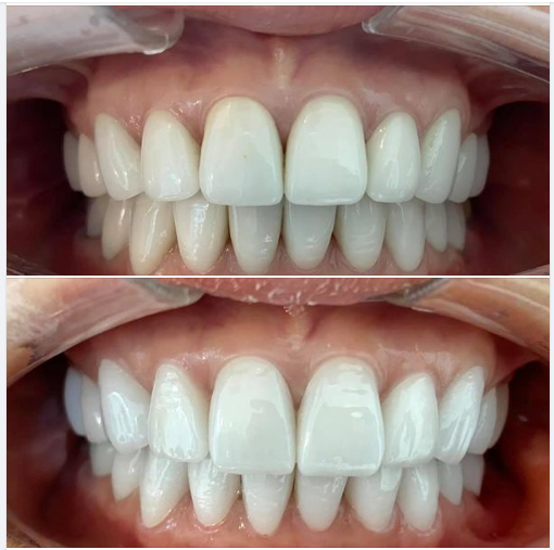 Răng sứ sau 10 năm sử dụng thì sẽ như thế nào