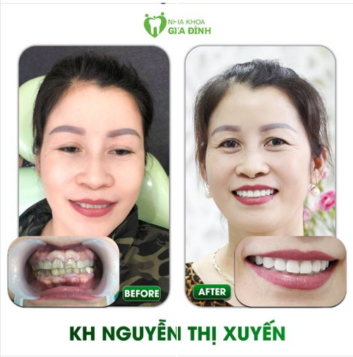 RĂNG SỨ THẨM MỸ ĐÃ GIÚP KHÁCH HÀNG THAY ĐỔI NỤ CƯỜI NHƯ THẾ NÀO