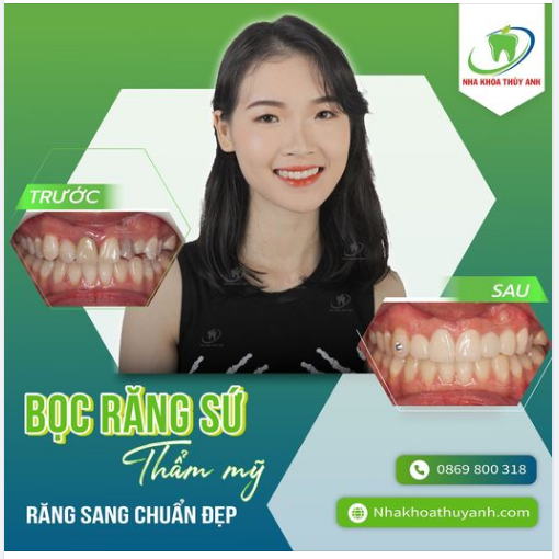 RĂNG SỨ THẨM MỸ - ĐẸP SANG NHƯ Ý