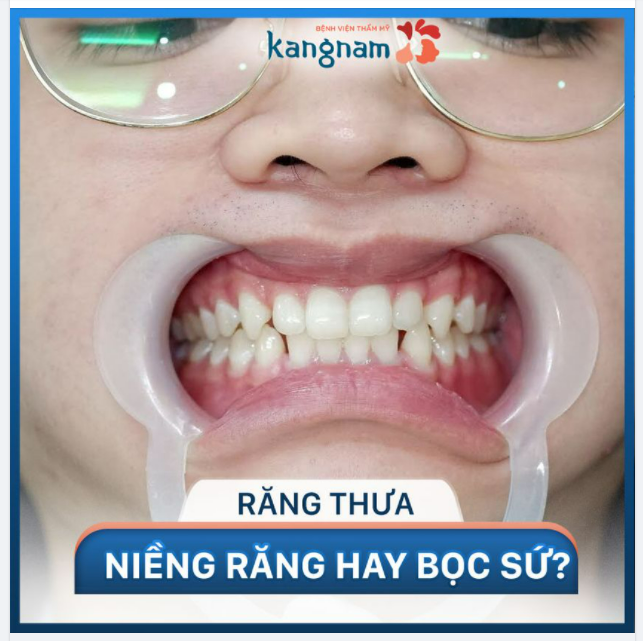 Răng thưa nên Niềng hay Bọc sứ?