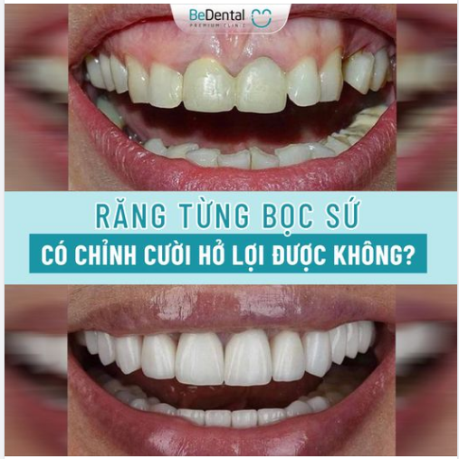 RĂNG TỪNG BỌC SỨ CÓ CHỈNH CƯỜI HỞ LỢI ĐƯỢC KHÔNG?