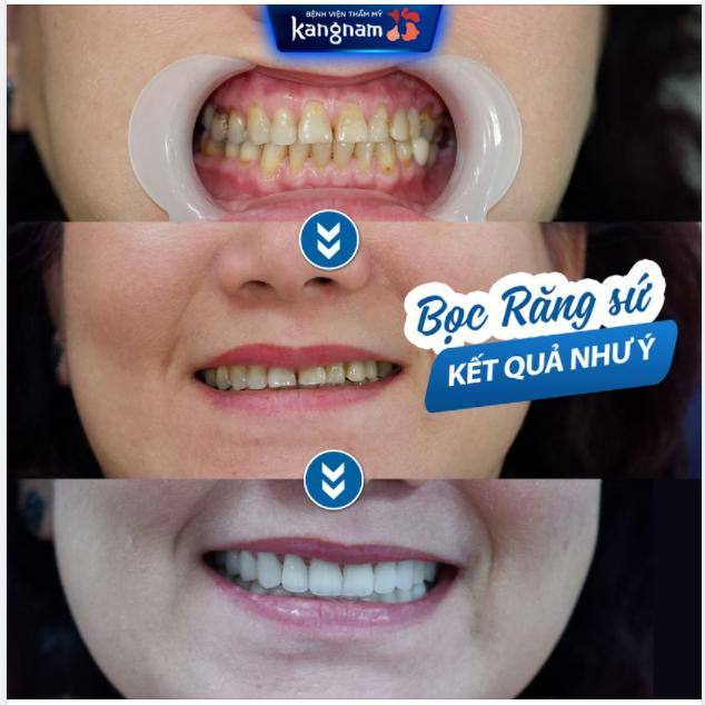 Răng xỉn màu, có vết ố với các màu vàng, nâu, xám,...